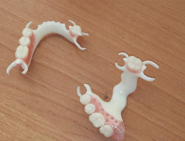 Clasp (bugel) prosthesis with Biodentaplast base